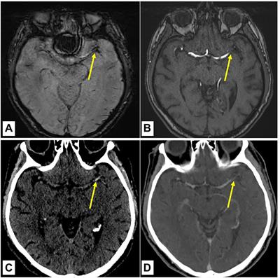 Absence of susceptibility vessel sign and hyperdense vessel sign in patients with cancer-related stroke